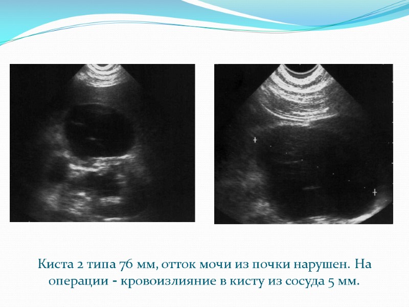 Киста 2 типа 76 мм, отток мочи из почки нарушен. На операции - кровоизлияние